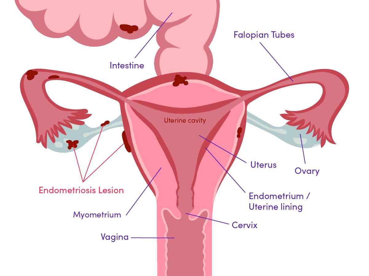 Endometriosis Diagram